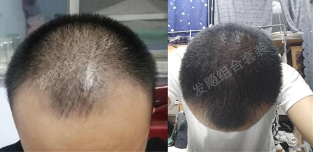 治愈脫發(fā)最新重大突破，重塑自信，希望之光再現(xiàn)