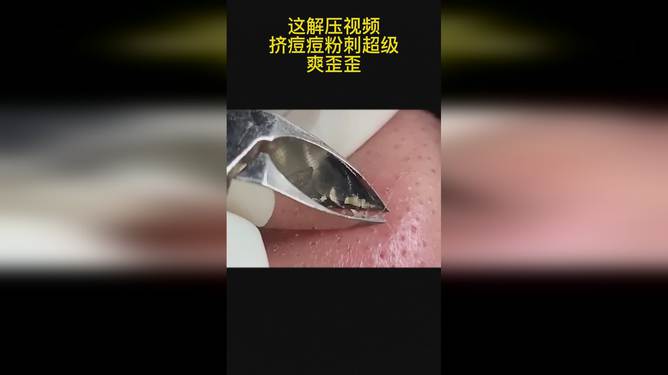 最新擠膿包視頻，見(jiàn)證變化的力量，自信與成就感的誕生之地
